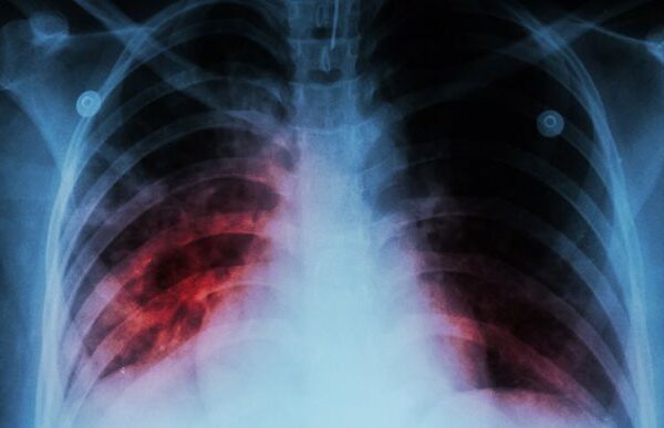 Световен ден за борба с туберкулозата: Напредък и предизвикателства в глобалния контекст.